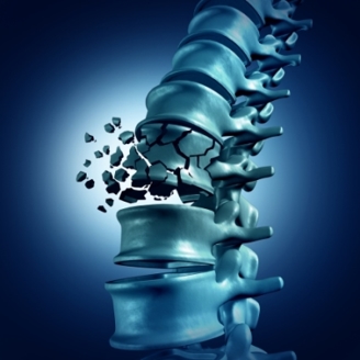 simulated photo of a shatter vertebrae