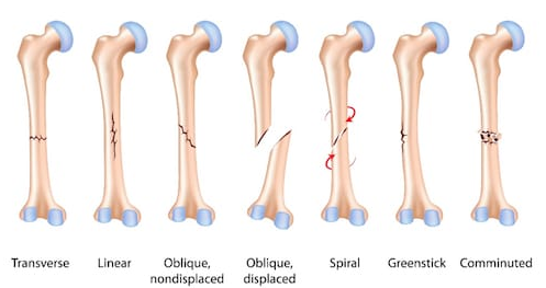 Infographic to different types of bone fractures: transverse, linear, oblique (nondisplaced), oblique (displaced), spiral, greenstick, comminuted