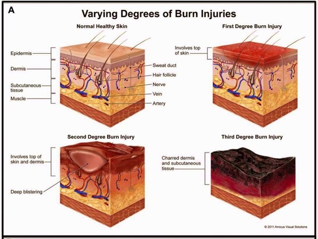 Varying degrees of burn injuries