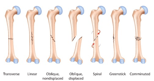 Spokane Broken Bone Lawyer | Sweetser Law Office